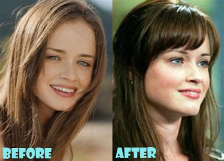 Alexis Bledel Plastic Surgery Before and After