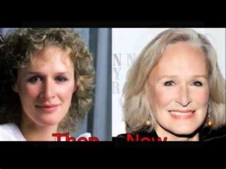 Glenn Close Plastic Surgery Before and After